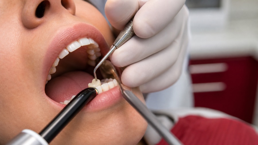 Tooth-coloured fillings